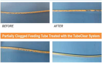 Prophylactic use of the TubeClear system reduces feeding tube material buildup and enables optimal enteral nutrition delivery.