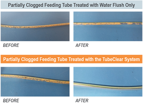 Prophylactic use of the TubeClear system reduces feeding tube material buildup and enables optimal enteral nutrition delivery.